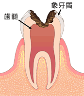 虫歯の症状：C3