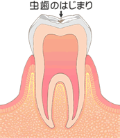 虫歯の症状：C0