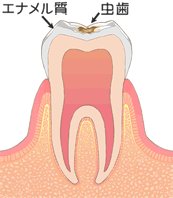 虫歯の症状：C1