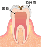 虫歯の症状：C2
