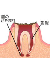 虫歯の症状：C4