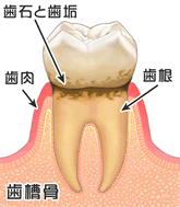 初期の歯周病の様子