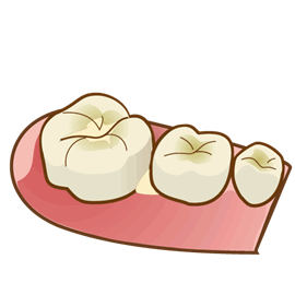 シーラントステップ１：子供の歯には細かな溝があります