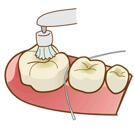 シーラントステップ２：歯をきれいにクリーニングします