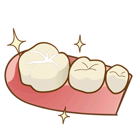 シーラントステップ３：歯の細かな傷をシーラントで埋めます